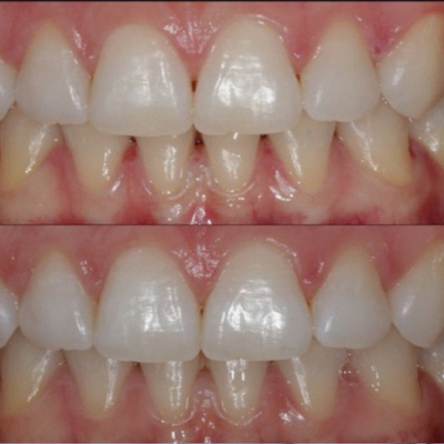 Combined bleaching