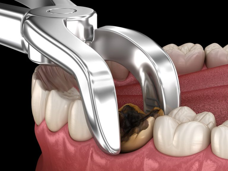 Tooth extraction