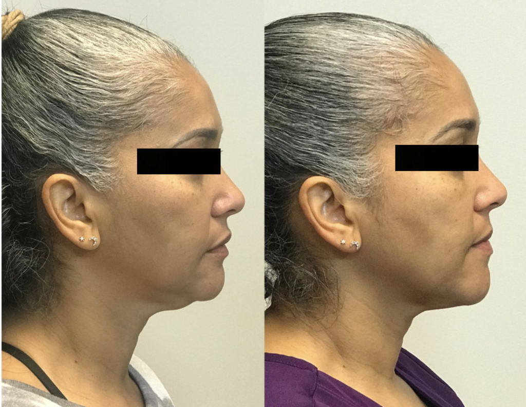 Deep Neck <br>Fat Graft<br> Liposuction