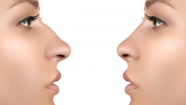  Primary Rhinoplasty