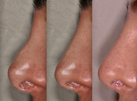 Secondary Rhinoplasty