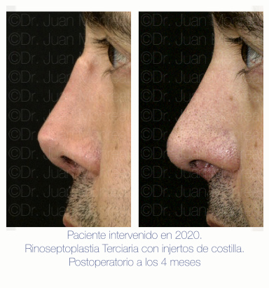 Tertiary Rhinoplasty