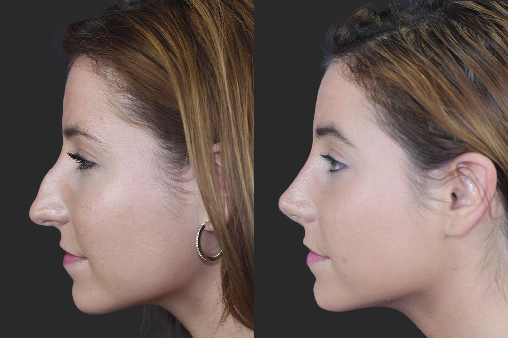 Above Tertiary Rhinoplasty
