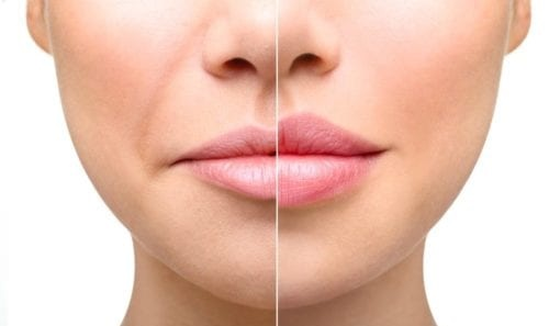 Lip Lift