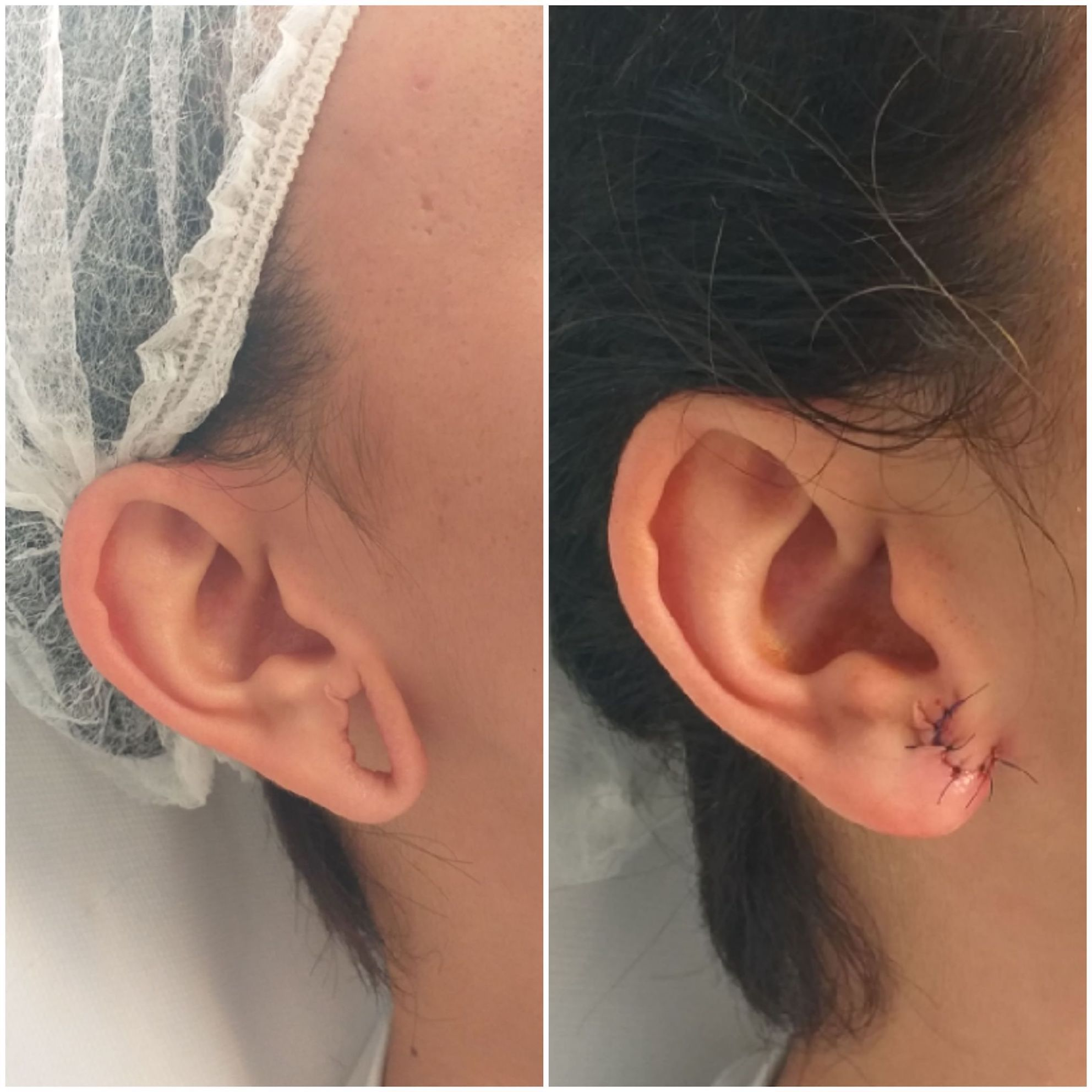 Lobuloplasty