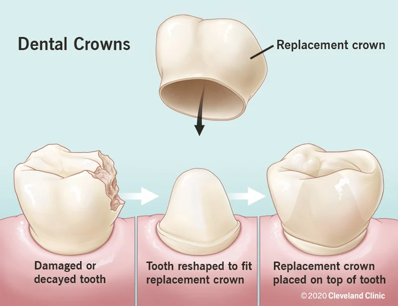 Crown on tooth