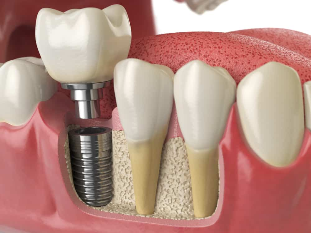 Crown on Implant