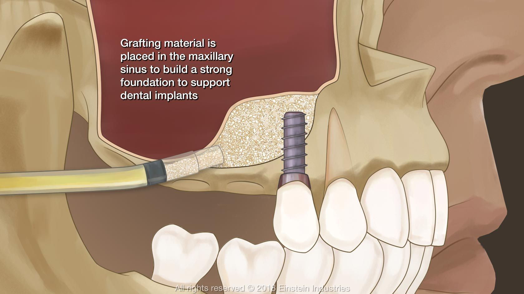 Maxillary Sinus Lift Graft