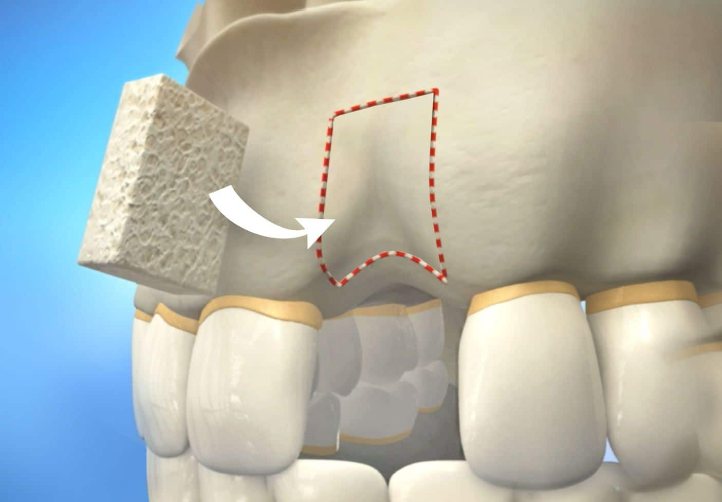 Gap Graft
