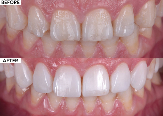 Resin veneer