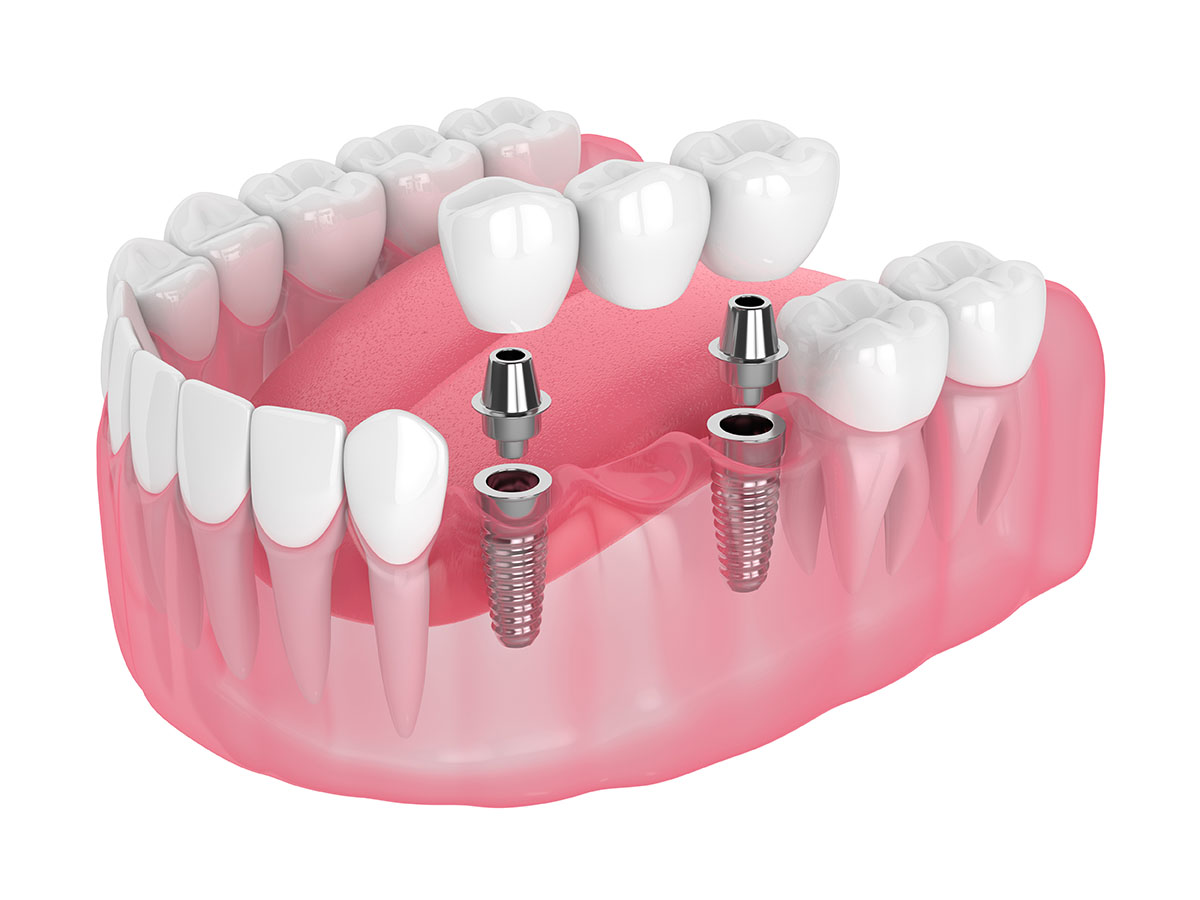 Single Dental Implant