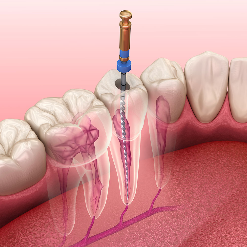 Endodontics