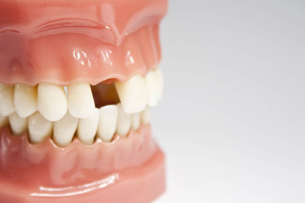 Temporary on Implant