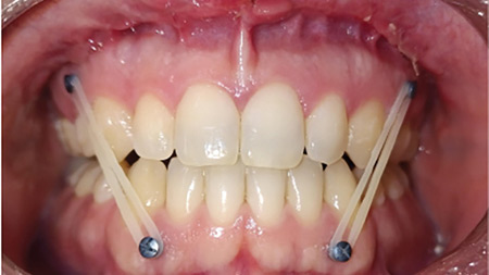 Uni-maxillary