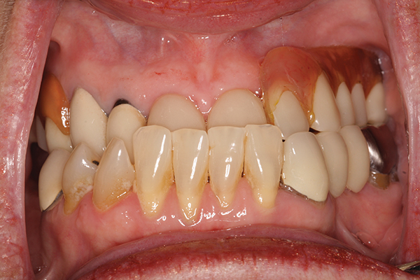Temporary Uni-Maxillary Prosthesis