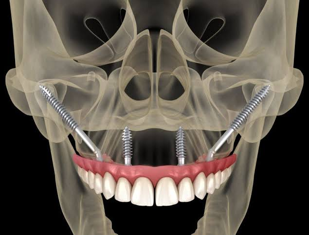 Zygomatic Package