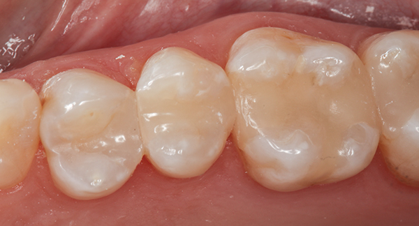 Composite resin restoration
