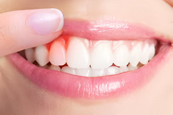 Severe periodontal treatment