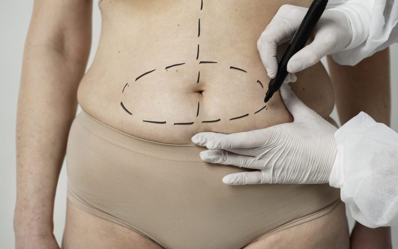 front-view-woman-with-marker-traces-belly