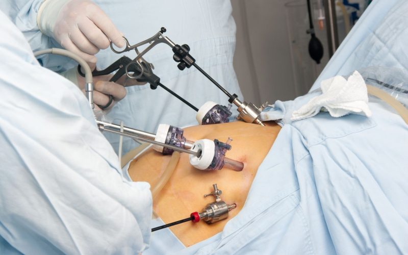 gastric_bypass_surgery-f45766f8acc64393bd5f8371dc00b99c
