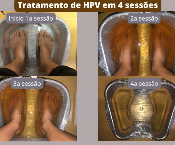 tratamento-de-hpv-em-4-sessoes (1)