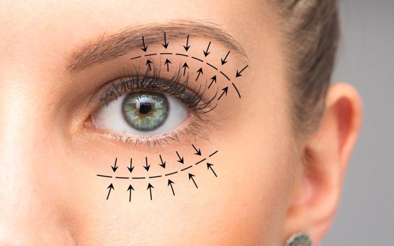 womans-eye-blepharoplasty